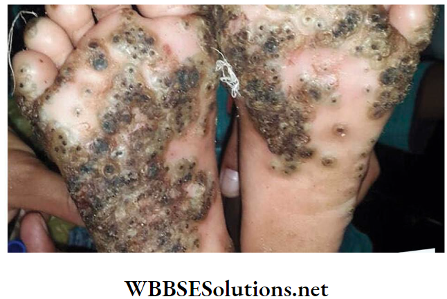 WBBSE Solutions For Class 10 Life Science And Environment Chapter 5 Topic 2 Environmental Pollution Black foot disease